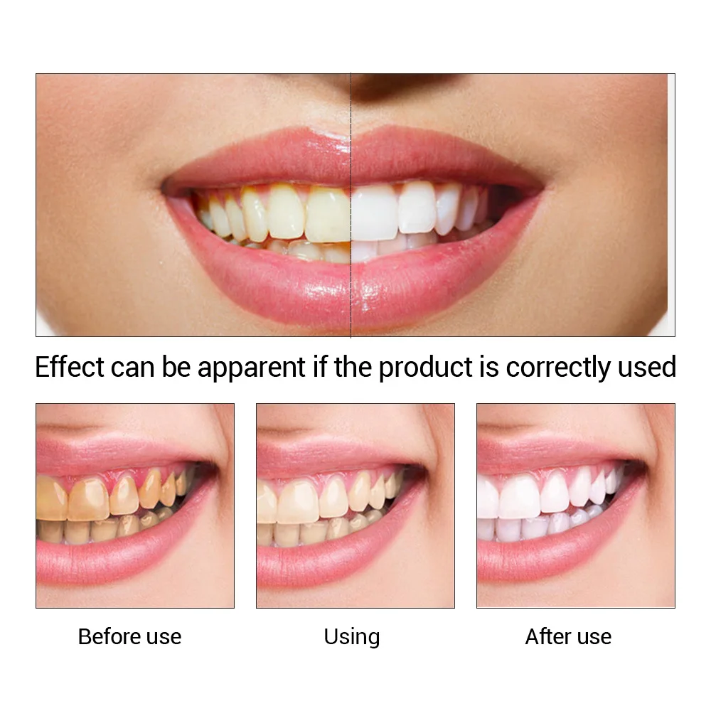 FTEENPLY Teeth Whitening Essen - огляд і ціна Teeth Whitening Gum